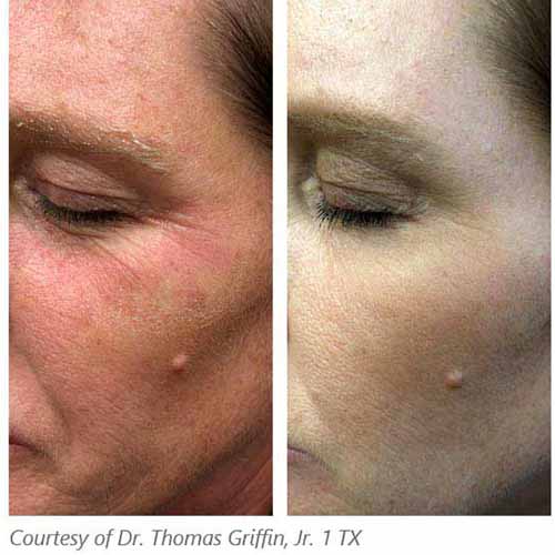 Subnovii Fibroblast Pen Treatment Before & After in Verona, NJ