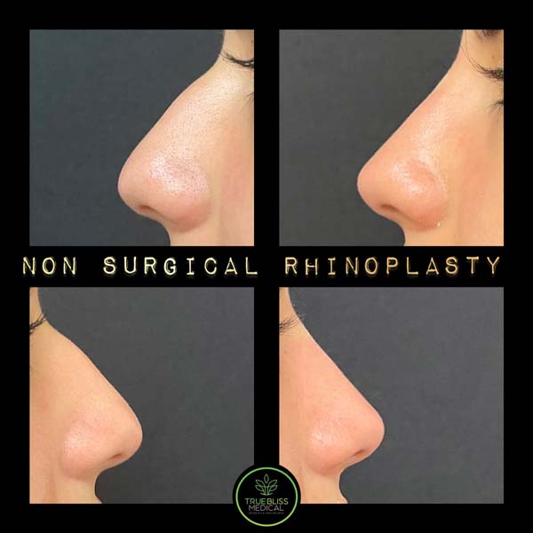 Non-Surgical Rhinoplasty Treatment in Verona NJ