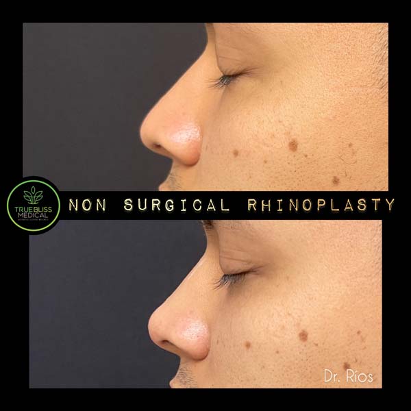 Non-Surgical Rhinoplasty Before & After in Verona, NJ