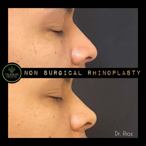Non-Surgical Rhinoplasty Treatment in Verona, NJ Non-Surgical Rhinoplasty Treatment in Verona, NJ