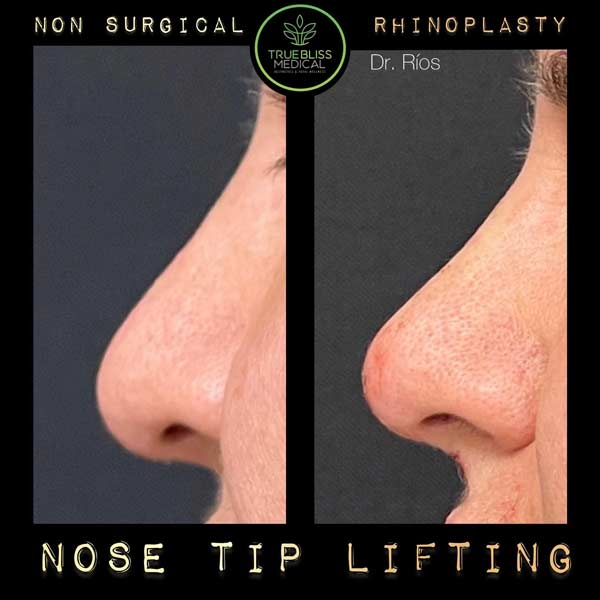 Non-Surgical Rhinoplasty Treatment in Verona NJ