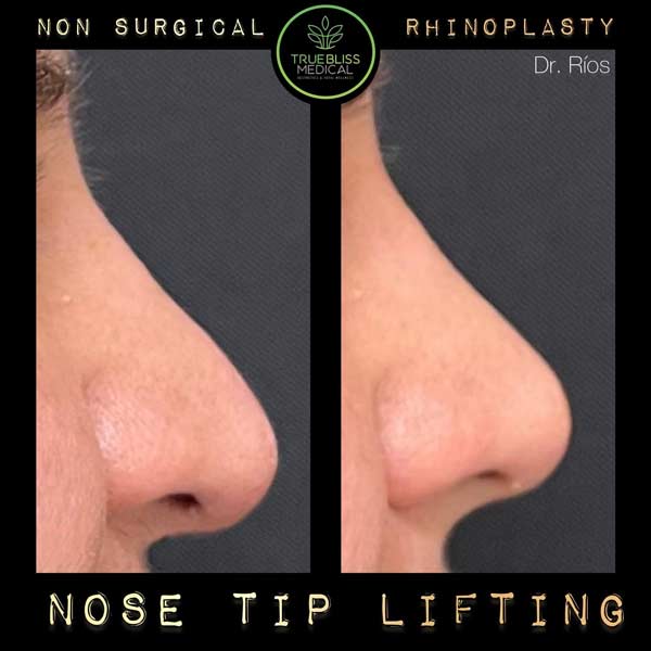 Non-Surgical Rhinoplasty Treatment in Verona NJ