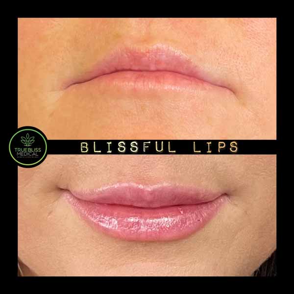 Lip Treatments Before & After in Verona, NJ