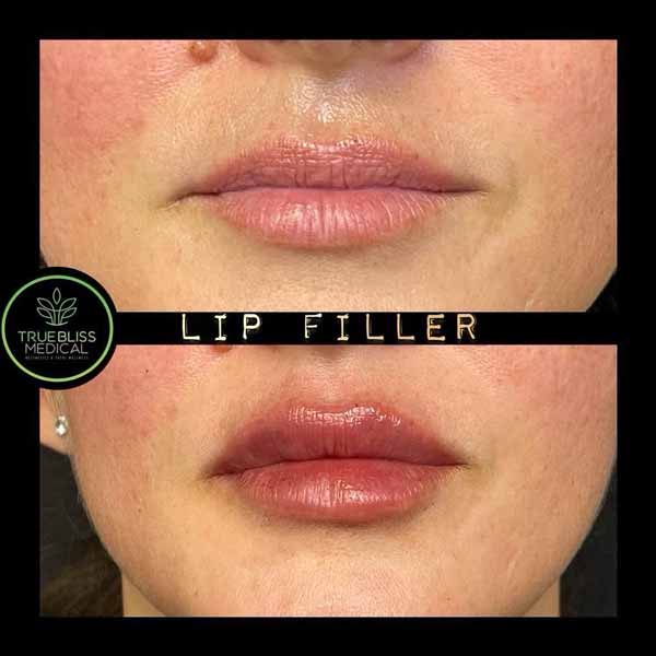 Lip Treatments Before & After in Verona, NJ