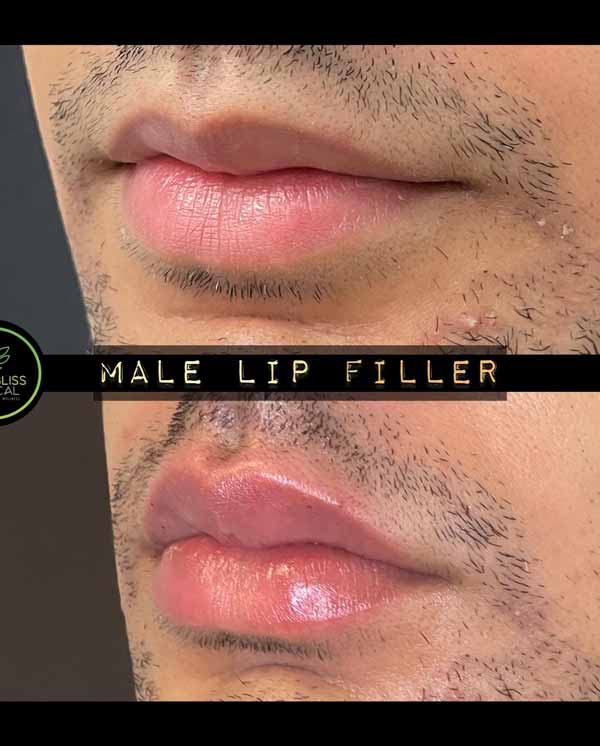 Lip Treatments Before & After in Verona, NJ