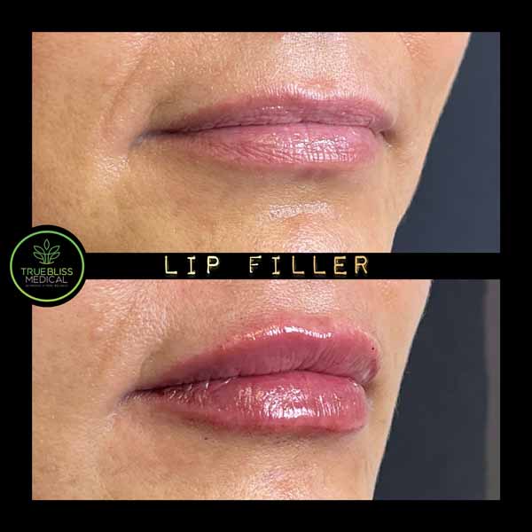 Lip Treatments Before & After in Verona, NJ