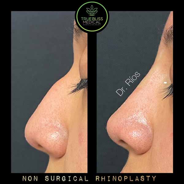 Non-Surgical Rhinoplasty Before & After in Verona, NJ