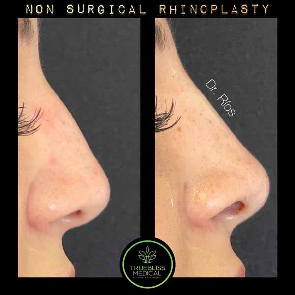 Non-Surgical Rhinoplasty Treatment in Verona NJ