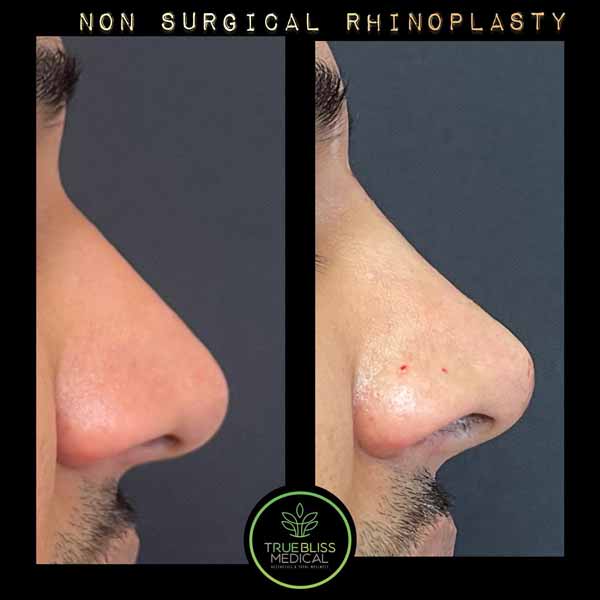 Non-Surgical Rhinoplasty Before & After in Verona, NJ