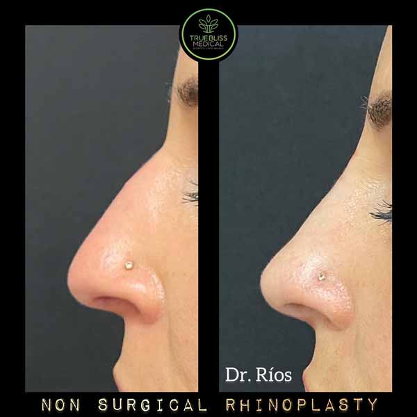 Non-Surgical Rhinoplasty Treatment in Verona NJ