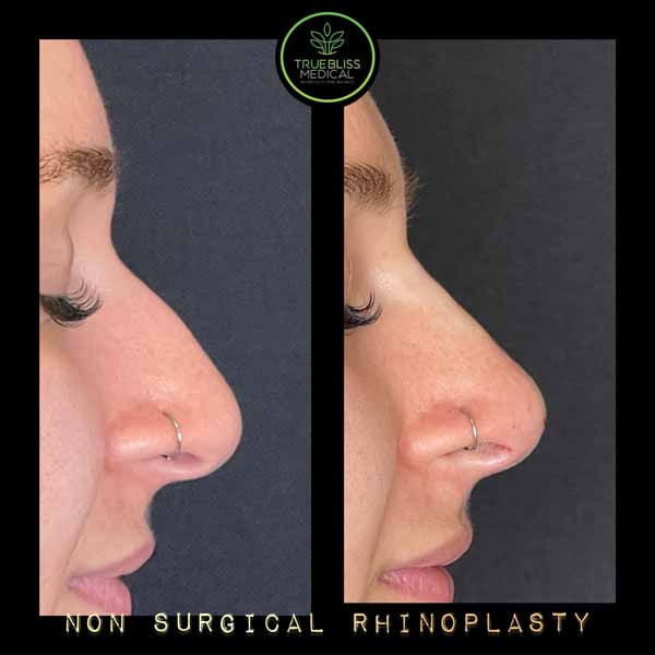 Non-Surgical Rhinoplasty Treatment in Verona NJ