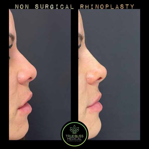 Non-Surgical Rhinoplasty Treatment in Verona NJ