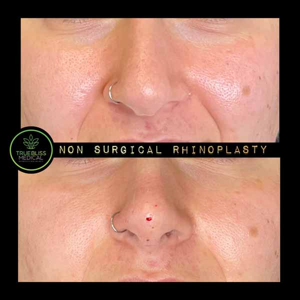 Non-Surgical Rhinoplasty Treatment in Verona NJ