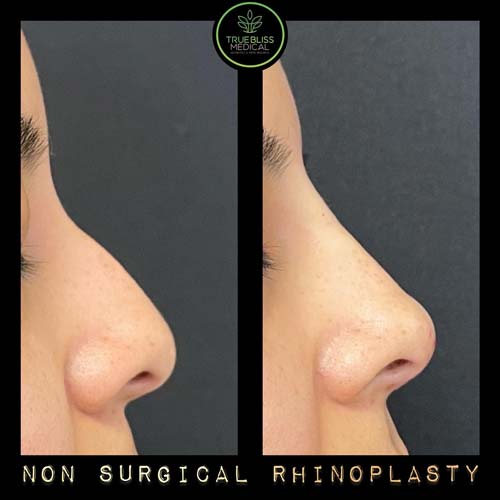 Non-Surgical Rhinoplasty Treatment in Verona NJ