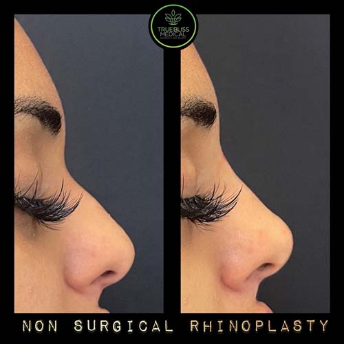 Non-Surgical Rhinoplasty Treatment in Verona NJ