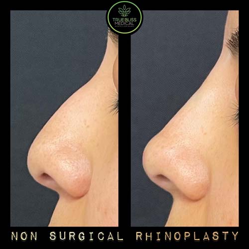 Non-Surgical Rhinoplasty Treatment in Verona, NJ Non-Surgical Rhinoplasty Treatment in Verona, NJ