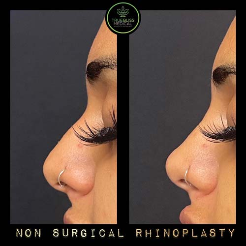 Non-Surgical Rhinoplasty Treatment in Verona NJ