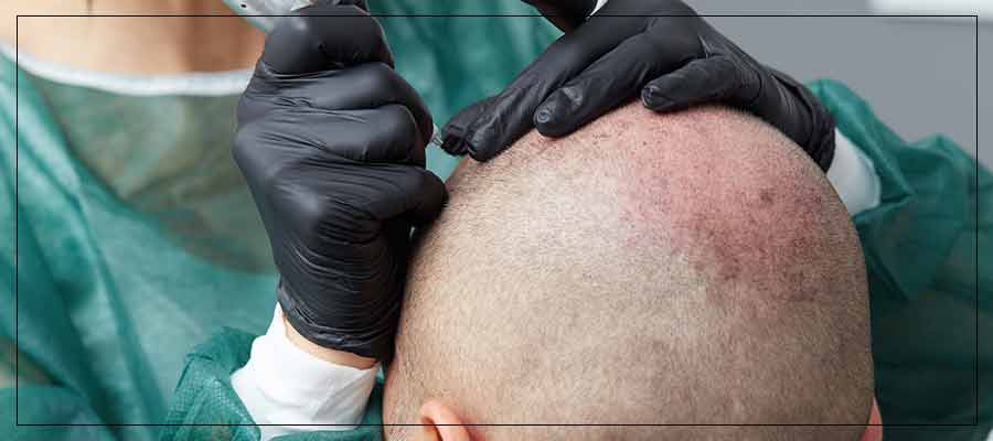 Scalp Micropigmentation Specialist Near Me in Verona NJ Scalp Micropigmentation Specialist Near Me in Verona NJ