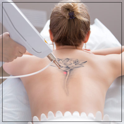 Tattoo Removal Specialist Near Me in Verona, NJ