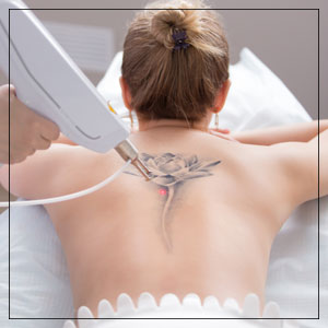 Tattoo Removal Specialist Near Me in Verona, NJ