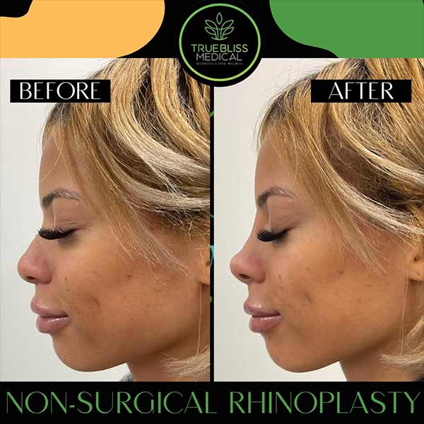 Non-Surgical Rhinoplasty Treatment in Verona NJ