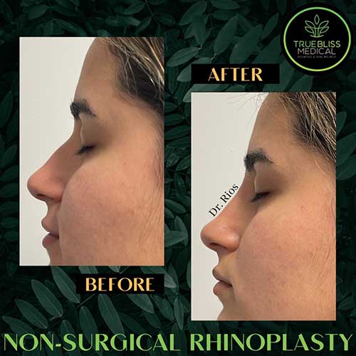 Non-Surgical Rhinoplasty Treatment in Verona NJ