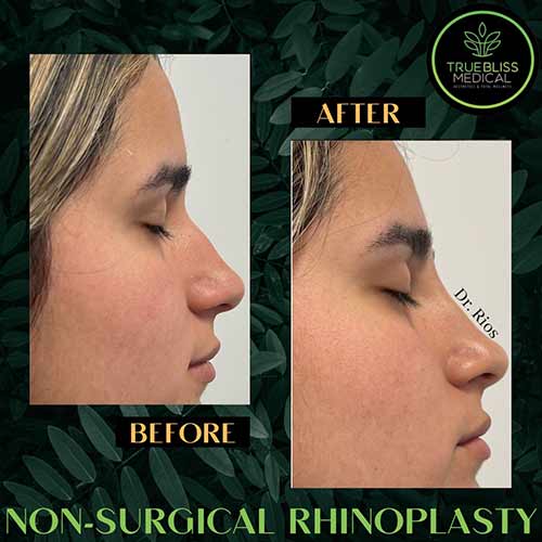 Non-Surgical Rhinoplasty Treatment in Verona NJ