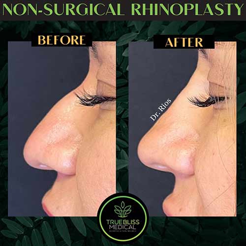 Non-Surgical Rhinoplasty Treatment in Verona NJ