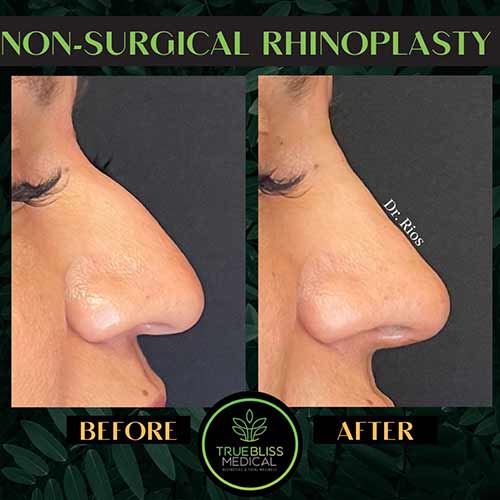 Non-Surgical Rhinoplasty Treatment in Verona NJ