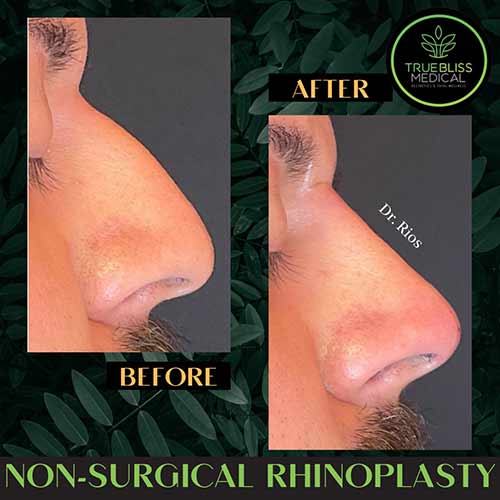 Non-Surgical Rhinoplasty Treatment in Verona NJ