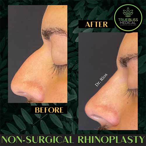 Non-Surgical Rhinoplasty Treatment in Verona NJ