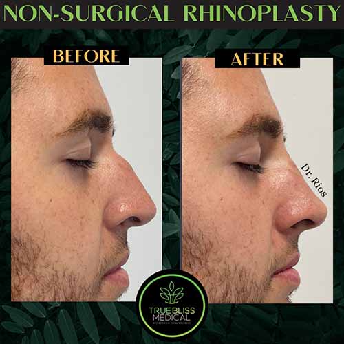 Non-Surgical Rhinoplasty Treatment in Verona NJ