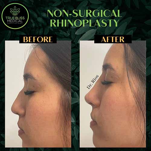 Non-Surgical Rhinoplasty Treatment in Verona NJ