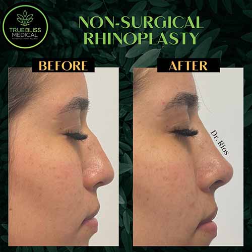 Non-Surgical Rhinoplasty Treatment in Verona NJ