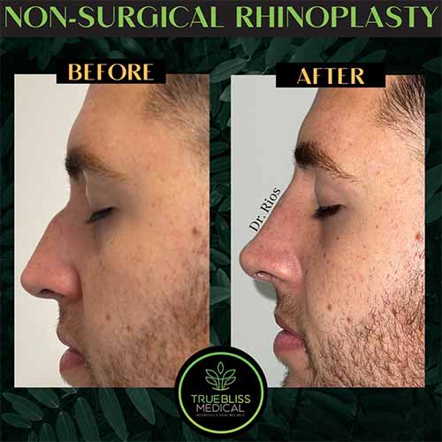 Non-Surgical Rhinoplasty Treatment in Verona NJ