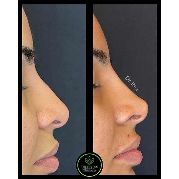 Non-Surgical Rhinoplasty Treatment in Verona NJ