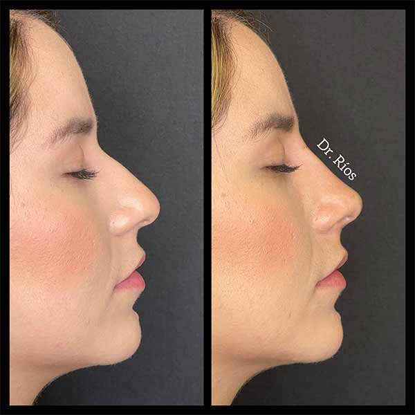 Non-Surgical Rhinoplasty Treatment in Verona NJ