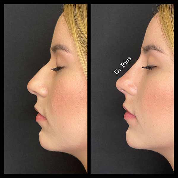 Non-Surgical Rhinoplasty Treatment in Verona NJ