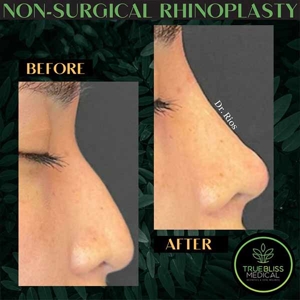 Non-Surgical Rhinoplasty Treatment in Verona NJ