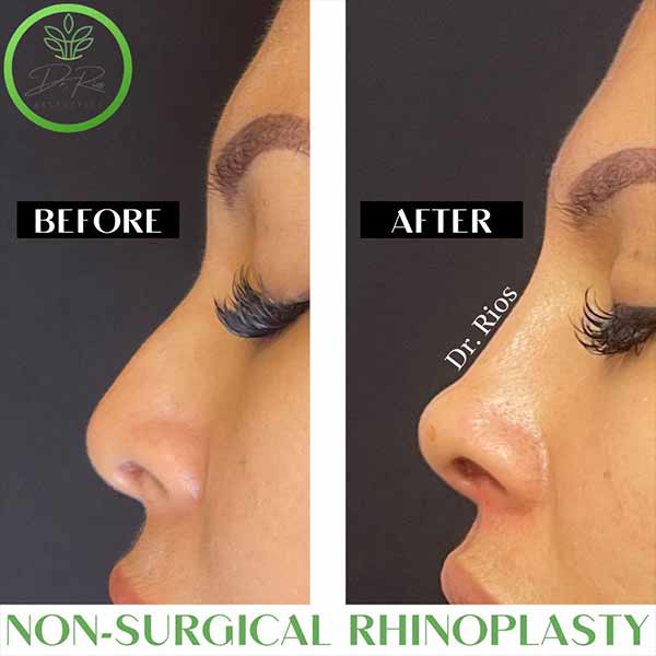 Non-Surgical Rhinoplasty Treatment in Verona NJ