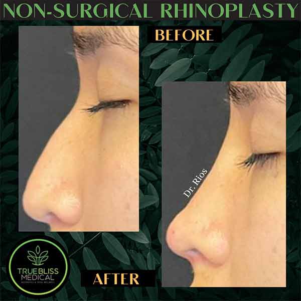 Non-Surgical Rhinoplasty Treatment in Verona NJ