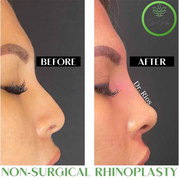 Non-Surgical Rhinoplasty Treatment in Verona NJ