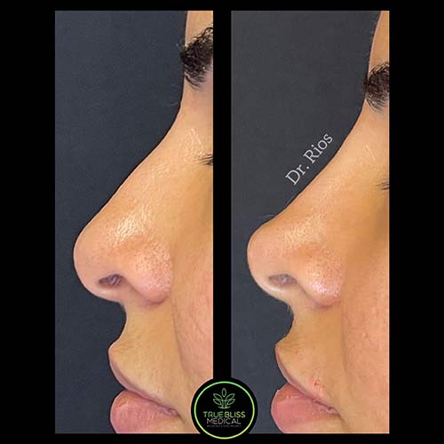 Non-Surgical Rhinoplasty Treatment in Verona NJ