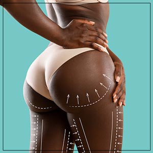 Non-Surgical Butt Lift Treatment Specialist Near Me in Verona, NJ