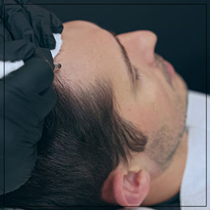 Scalp Micropigmentation Treatment Specialist Near Me in Verona, NJ Scalp Micropigmentation Treatment Specialist Near Me in Verona, NJ