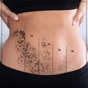 Tattoo Removal Treatment Specialist Near Me in Verona, NJ