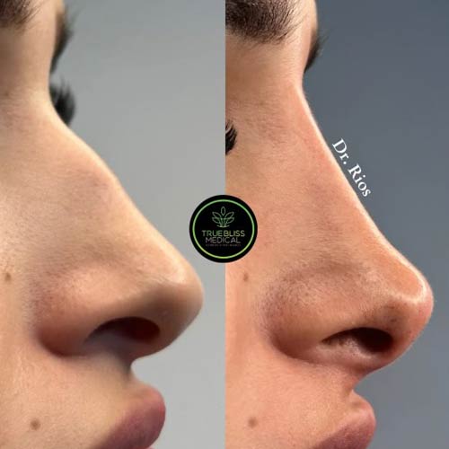 Non-Surgical Rhinoplasty Treatment in Verona, NJ Non-Surgical Rhinoplasty Treatment in Verona, NJ