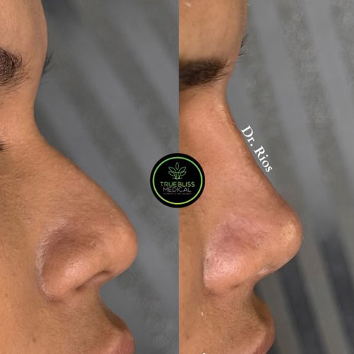 Non-Surgical Rhinoplasty Treatment in Verona NJ