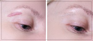 Botox for Hypertrophic Scars in Verona, NJ Botox for Hypertrophic Scars in Verona, NJ