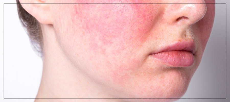 Mesobotox for Rosacea: A Soothing Solution for Sensitive Skin by Dr. Rios Mesobotox for Rosacea: A Soothing Solution for Sensitive Skin by Dr. Rios